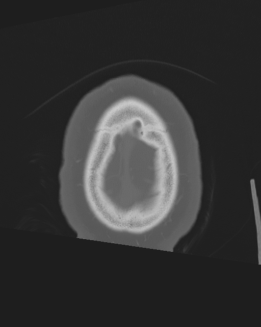 Bone-anchored hearing aid (Radiopaedia 38708-40866 Axial bone window 8).png