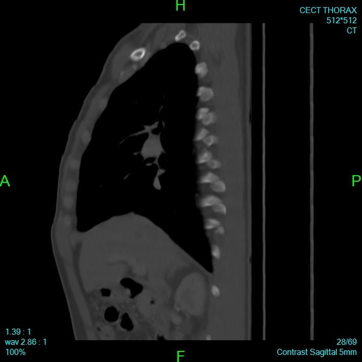 Bone metastases from lung carcinoma (Radiopaedia 54703-60937 Sagittal bone window 28).jpg