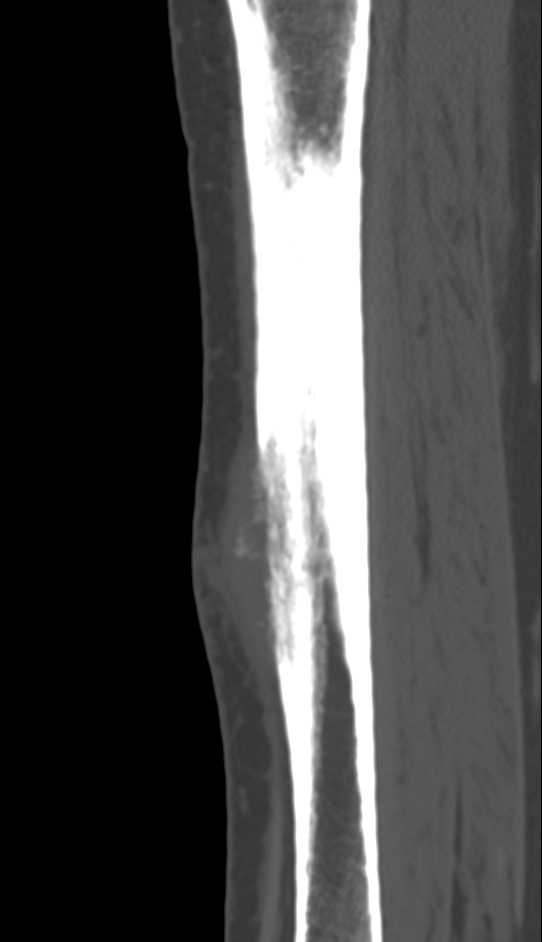 Bone metastasis - tibia (Radiopaedia 57665-64609 Sagittal bone window 96).jpg
