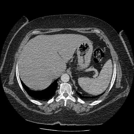 Bovine aortic arch - right internal mammary vein drains into the superior vena cava (Radiopaedia 63296-71875 A 154).jpg