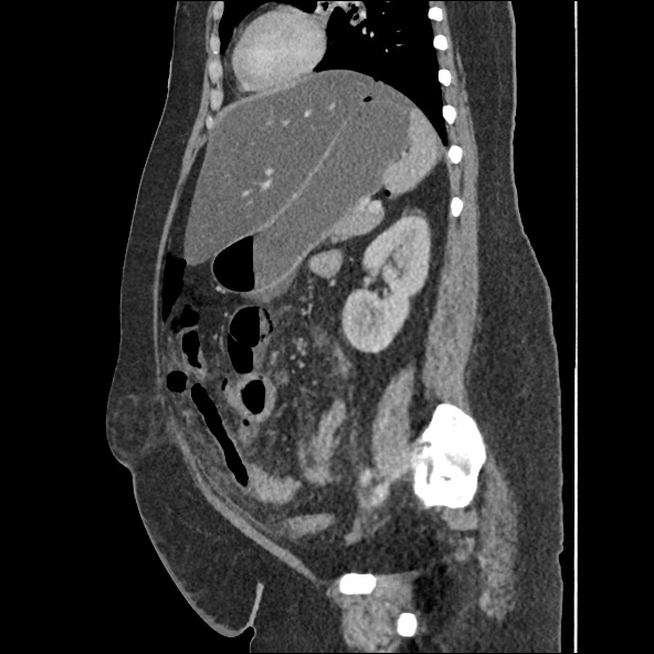Bowel and splenic infarcts in acute lymphocytic leukemia (Radiopaedia 61055-68915 C 27).jpg