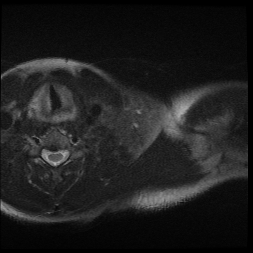 File:Brachial plexus neurofibroma (Radiopaedia 28030-28291 Axial T2 fat sat 15).png