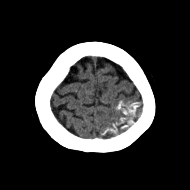 Brain cortical laminar necrosis (Radiopaedia 25822-25971 Axial non-contrast 41).jpg