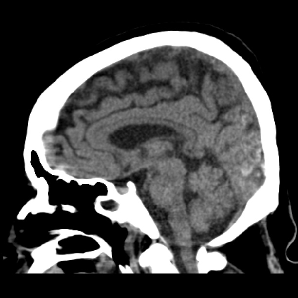 Brain cortical laminar necrosis (Radiopaedia 25822-25971 non-contrast 25).jpg