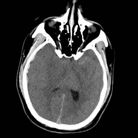 File:Brain death after motor vehicle collision (Radiopaedia 88470-105114 Axial 3).png