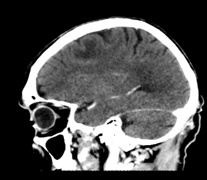 Brain metastases from lung cancer (Radiopaedia 27849-28092 Sagittal C+ delayed 43).jpg