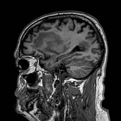 Brain metastases from lung cancer (Radiopaedia 83839-99028 Sagittal T1 36).jpg