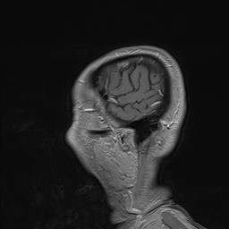 Brain metastasis (Radiopaedia 42617-45761 Sagittal T1 C+ 10).jpg