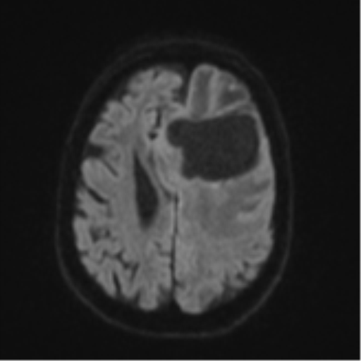 Brain metastasis (lung cancer) (Radiopaedia 48289-53179 Axial DWI 48).png