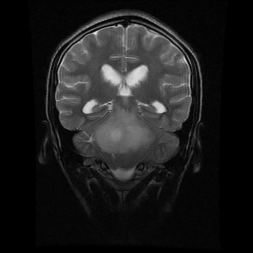 File:Brainstem glioma (Radiopaedia 30923-31624 Coronal T2 8).jpg