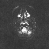 Brainstem glioma (Radiopaedia 67531-76922 Axial DWI 27).jpg