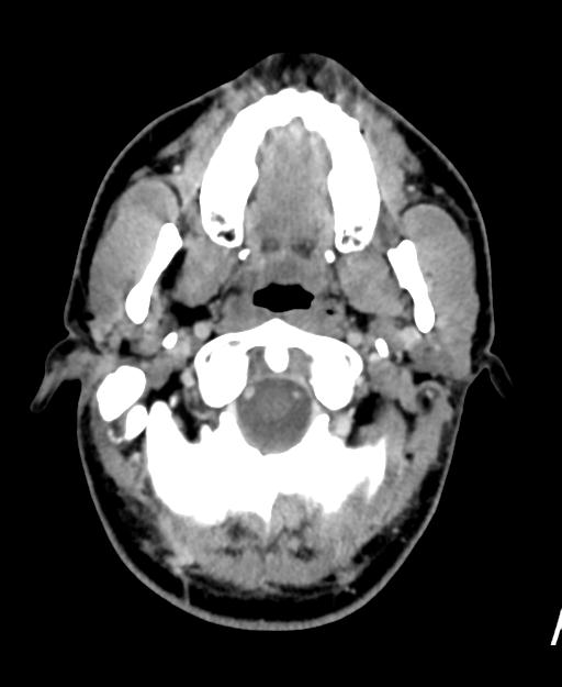 Branchial cleft cyst (Radiopaedia 31167-31875 Axial C+ delayed 10).jpg