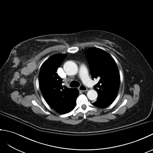 Breast carcinoma with pathological hip fracture (Radiopaedia 60314-67974 A 21).jpg