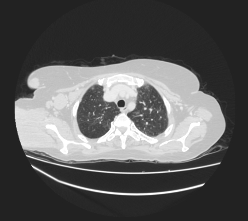 Breast metastases from facial malignant melanoma (Radiopaedia 60316-67975 Axial lung window 18).jpg