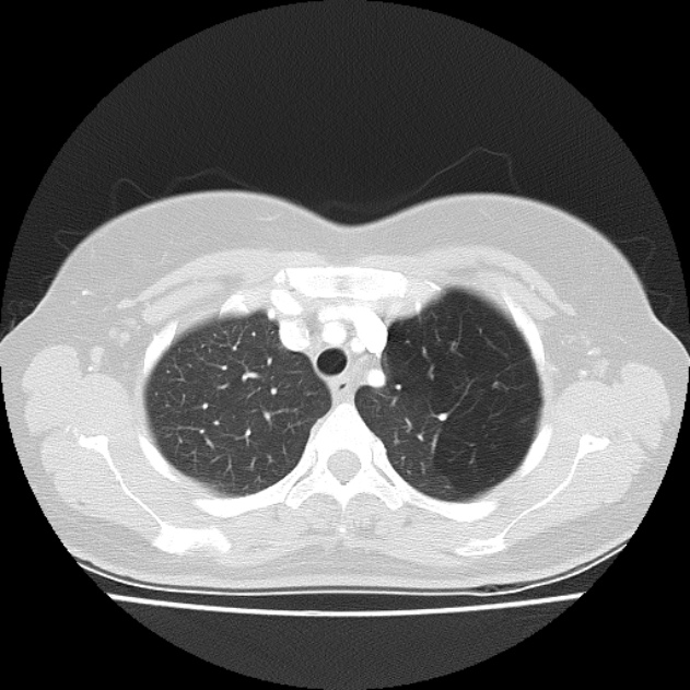 Bronchial atresia (Radiopaedia 22965-22992 Axial lung window 41).jpg