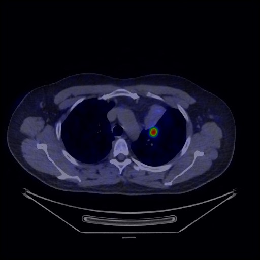 Bronchial carcinoid tumor (Radiopaedia 67377-76765 68Ga-DOTATATE PET-CT 24).jpg
