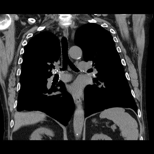 File:Bronchial stenosis - lung transplant (Radiopaedia 73133-83848 Coronal non-contrast 39).jpg