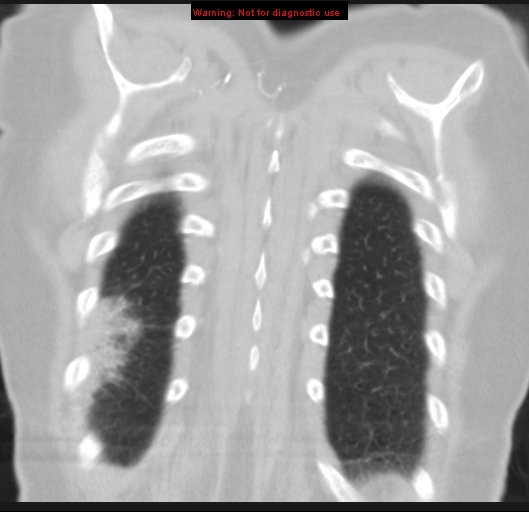Bronchoalveolar carcinoma (BAC) (Radiopaedia 13436-13392 Coronal lung window 54).jpg