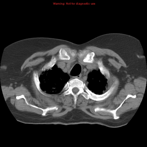 Bronchoalveolar carcinoma (Radiopaedia 13224-13233 Axial non-contrast 8).jpg