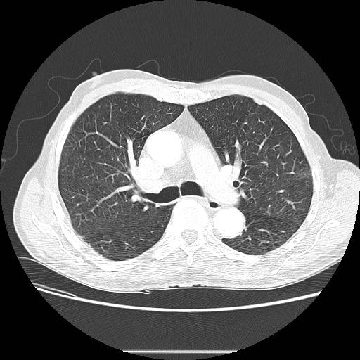 File:Bronchocele (Radiopaedia 17097-16795 Axial lung window 50).jpg