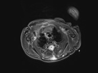 File:Bronchogenic cyst (Radiopaedia 27207-27380 Axial STIR 13).jpg