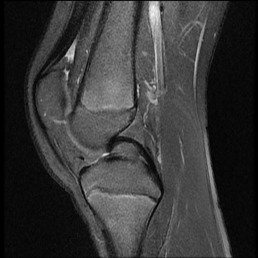 File:Bucket handle tear - lateral meniscus (Radiopaedia 72124-82634 Sagittal PD fat sat 9).jpg