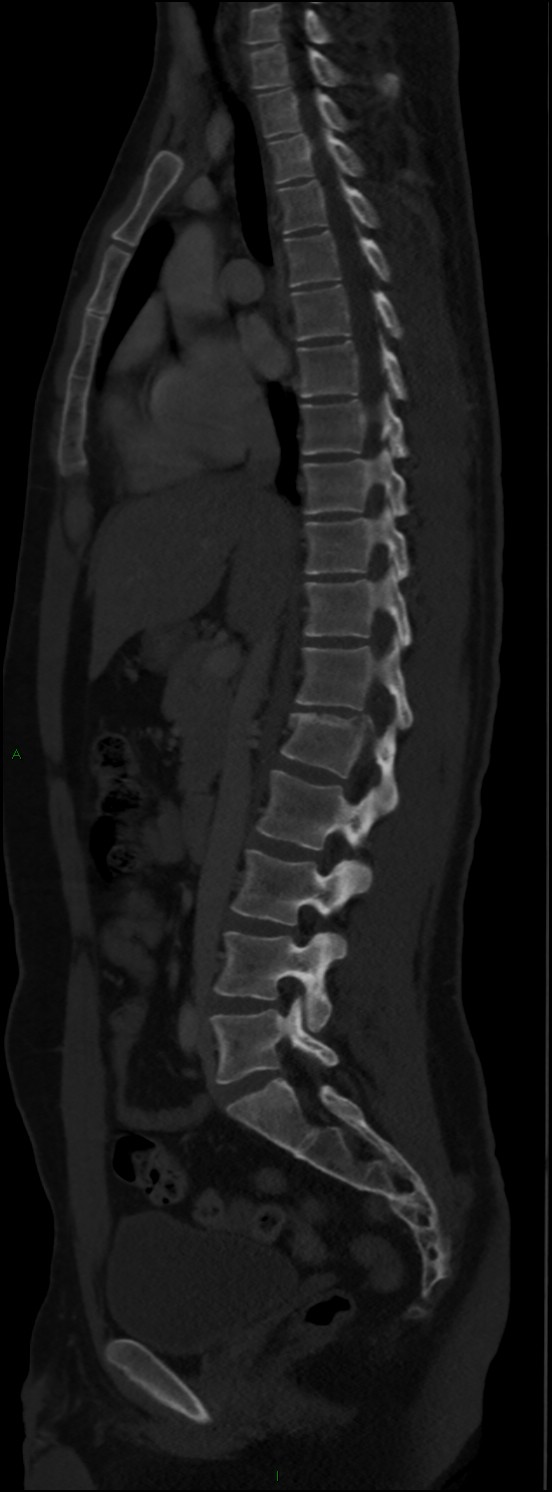 Burst fracture (Radiopaedia 83168-97542 Sagittal bone window 64).jpg