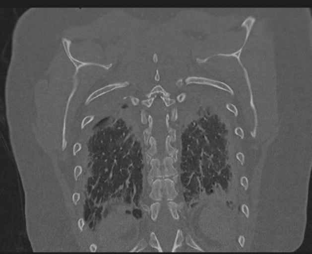 File:Burst fracture - thoracic spine (Radiopaedia 30238-30865 Coronal bone window 132).jpg