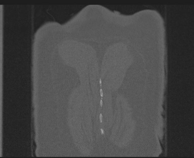 Burst fracture - thoracic spine (Radiopaedia 30238-30865 Coronal bone window 156).jpg