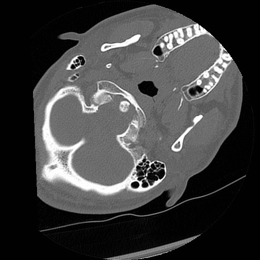 C1-C2 "subluxation" - normal cervical anatomy at maximum head rotation (Radiopaedia 42483-45607 Axial non-contrast 61).jpg