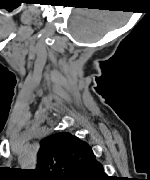 C2 fracture with vertebral artery dissection (Radiopaedia 37378-39199 D 63).png