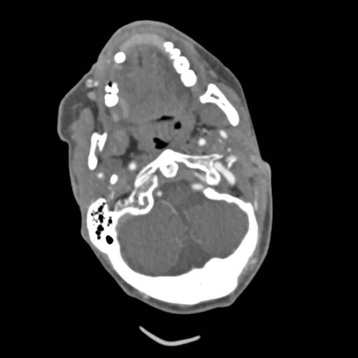 File:C2 fracture with vertebral artery dissection (Radiopaedia 37378-39200 A 183).png