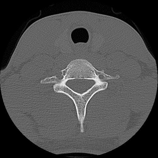File:C5 facet fracture (Radiopaedia 58374-65499 Axial bone window 71).jpg