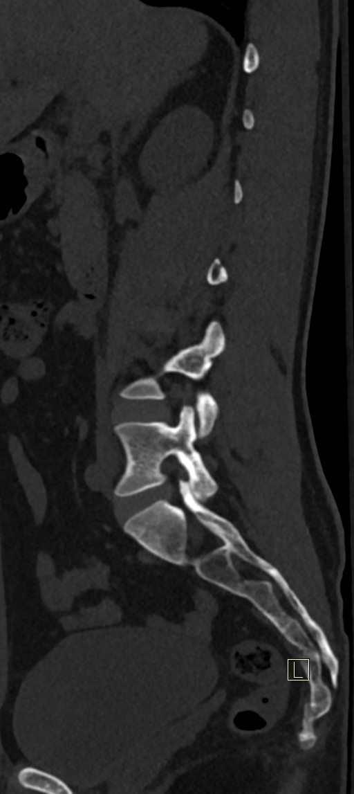 Calcaneal fractures with associated L2 burst fracture (Radiopaedia 71671-82493 Sagittal bone window 56).jpg