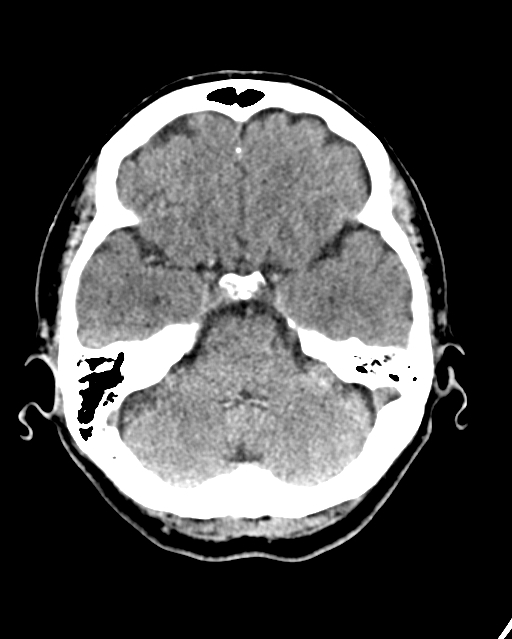 Calcified meningioma (Radiopaedia 74361-85243 Axial non-contrast 37).jpg
