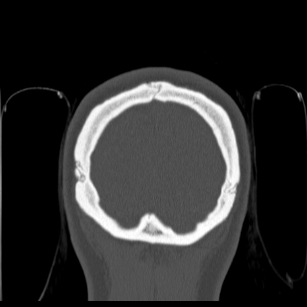 Calvarial osteoma (Radiopaedia 36520-38079 C 87).jpg