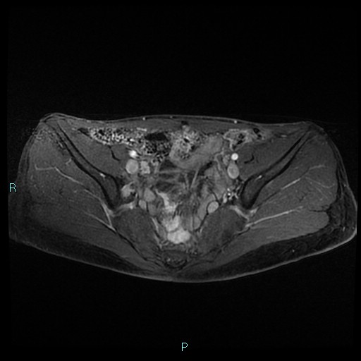 File:Canal of Nuck cyst (Radiopaedia 55074-61448 Axial T1 C+ fat sat 21).jpg