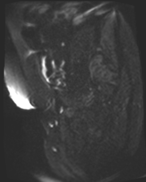 Cancer cervix - stage IIb (Radiopaedia 75411-86615 Sagittal DWI 45).jpg