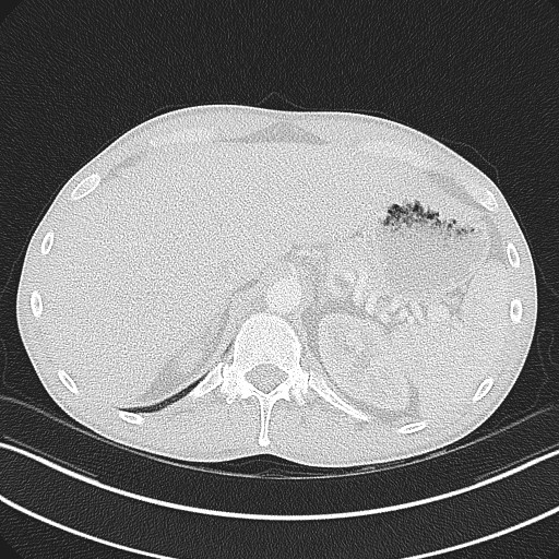 Cannonball metastases - testicular choriocarcinoma (Radiopaedia 84510-99891 Axial lung window 91).jpg