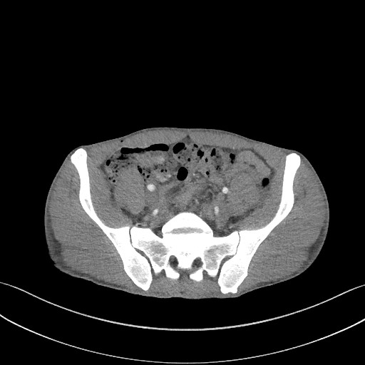 File:Cannonball metastases - testicular choriocarcinoma (Radiopaedia 84510-99891 B 166).jpg