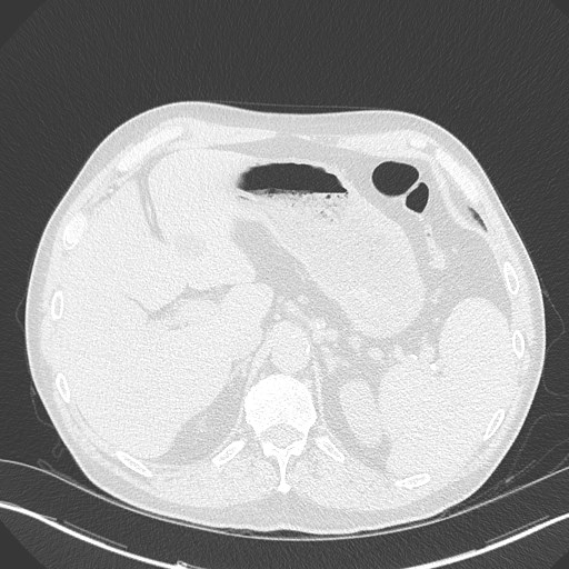 Caplan syndrome (Radiopaedia 56667-63530 Axial lung window 188).jpg