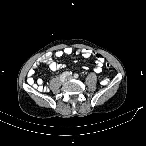 File:Caput medusae sign - portal hypertension (Radiopaedia 64007-72759 A 64).jpg