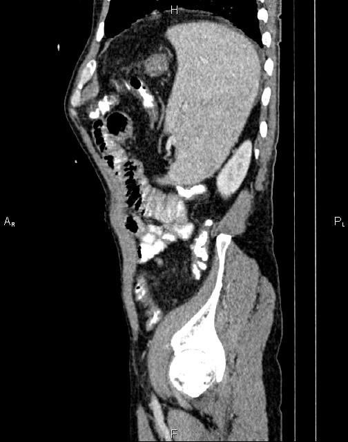 Caput medusae sign - portal hypertension (Radiopaedia 64007-72759 B 71).jpg
