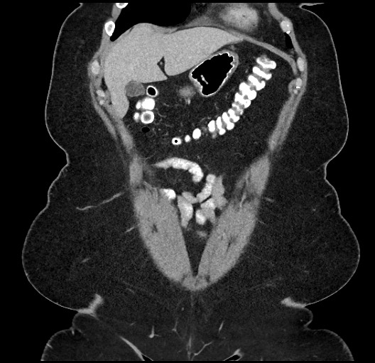 Carcinoid tumor - terminal ileum (Radiopaedia 60931-68739 B 7).jpg
