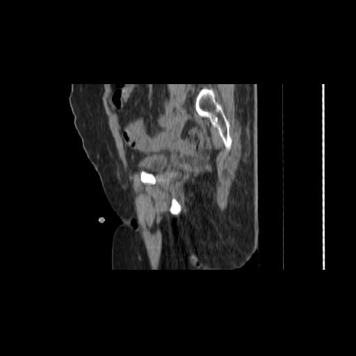 File:Carcinoma cervix- brachytherapy applicator (Radiopaedia 33135-34173 D 54).jpg