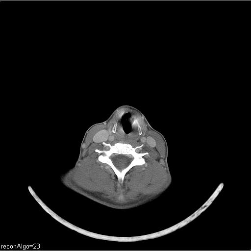 Carcinoma of the maxillary antrum (Radiopaedia 53805-59888 Axial C+ delayed 16).jpg