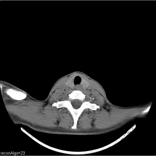 Carcinoma of the maxillary antrum (Radiopaedia 53805-59888 Axial non-contrast 15).jpg