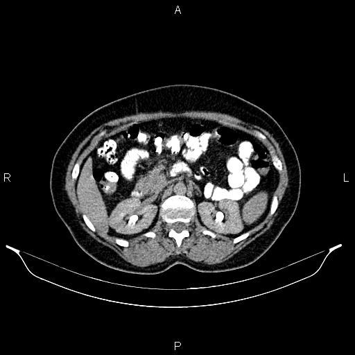 File:Carcinoma of uterine cervix (Radiopaedia 85861-101700 Axial C+ delayed 21).jpg