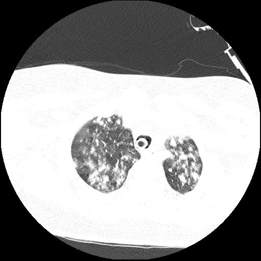 Cardiac angiosarcoma (Radiopaedia 66010-75181 Axial lung window 78).jpg