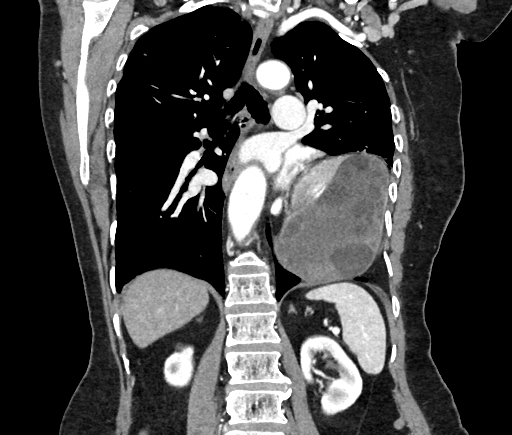 Cardiac hydatid disease (Radiopaedia 64684-73611 Axial reconstruction 35).jpg